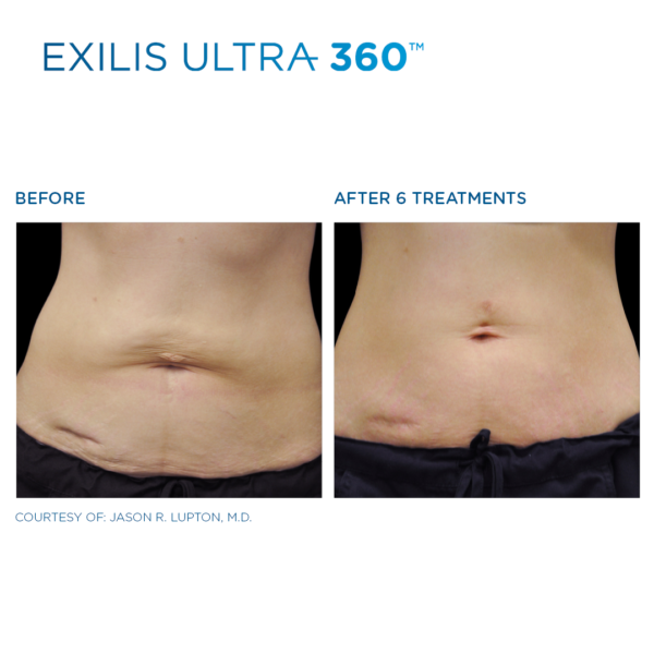 EXILIS_9
